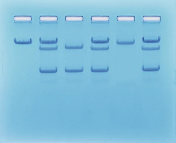 På jagt efter Seglcelleanæmi  (778116)